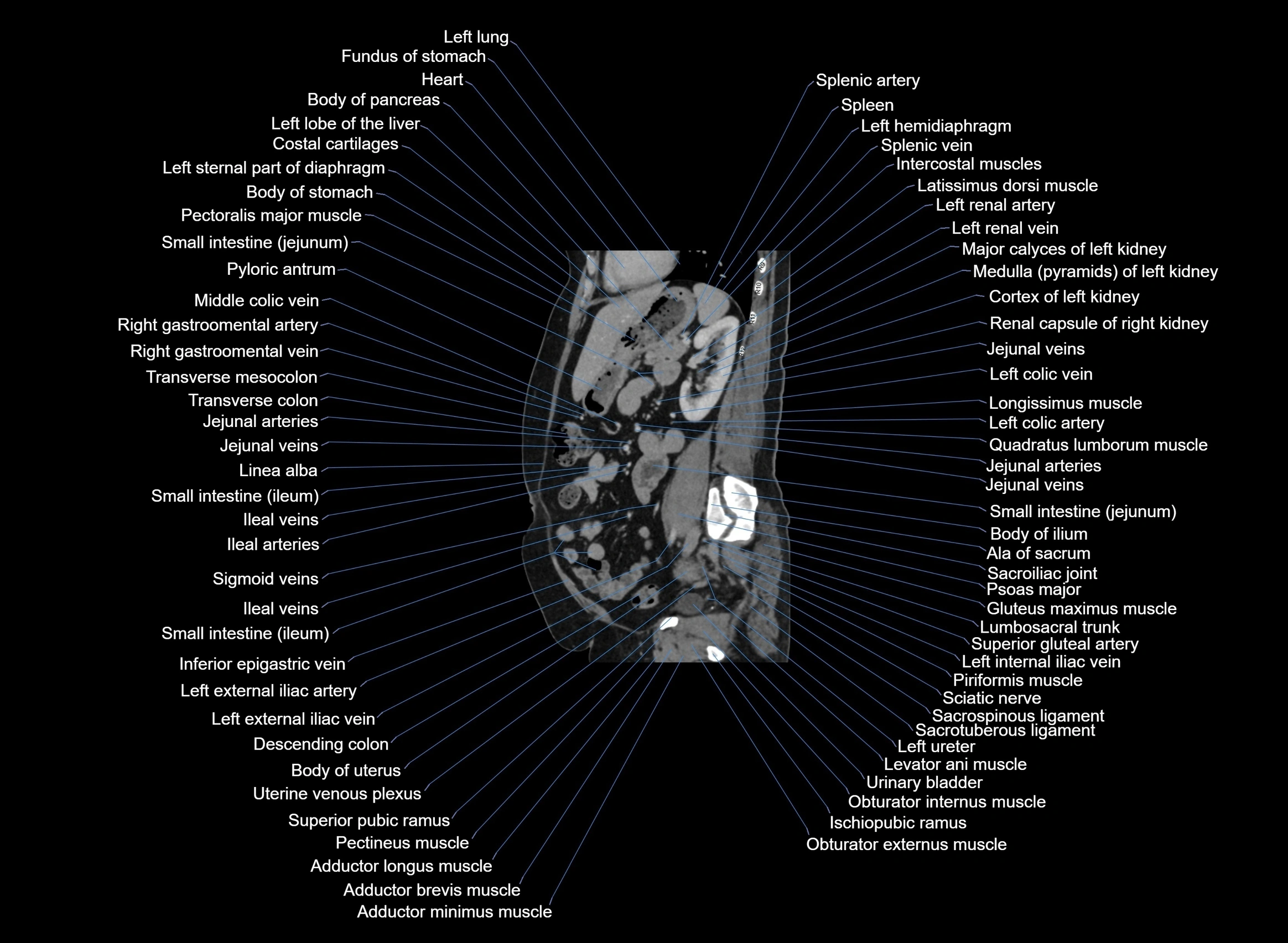 CT Abdomen sagittal cross sectional anatomy labelled radiology image -00043.webp